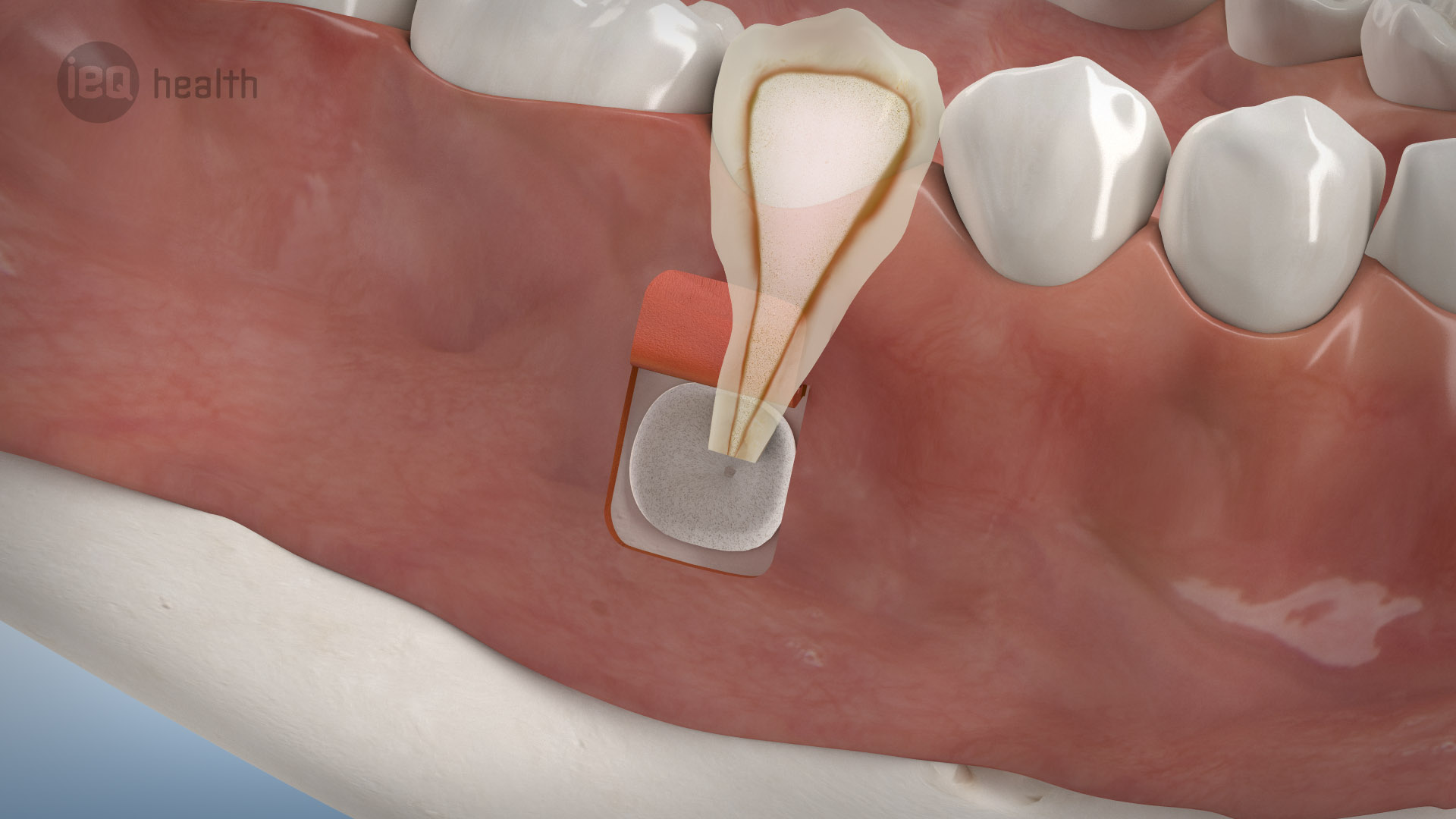 Wurzelspitzenresektion In Herne Oralchirurg